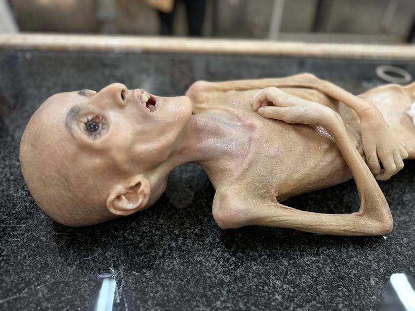 Gazze'de yetersiz beslenme sonucu ölen Filistinli çocuktan geriye bir deri bir kemik fotoğrafları kaldı - Resim: 2