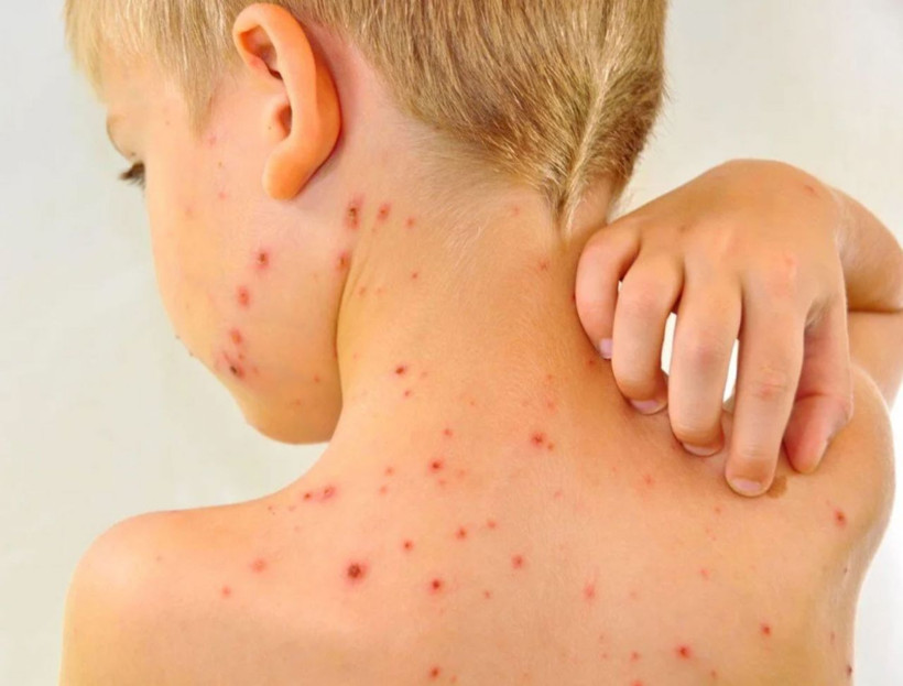 Yeni salgın kabusu! 'Domates Gribi' çocukları vuruyor ve çok hızlı bulaşıyor belirtisi neler tedavisi var mı? - Resim: 4