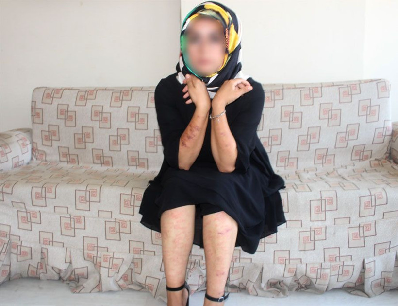 Adıyaman'da güzellik merkezinde lazer epilasyon yaptıran kadının vücudu yandı! - Resim: 1