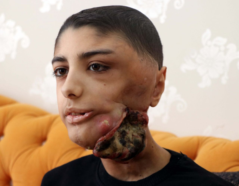 Gaziantep'te yüzünde çıktı bir daha kapanmadı! Berat'ın yarası her gün büyüyor - Resim: 3