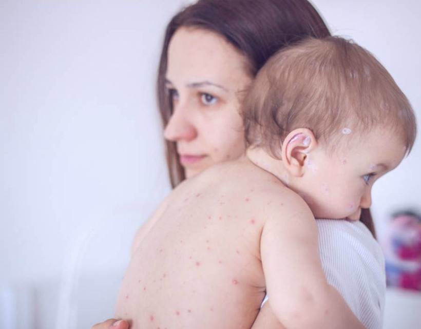 İstanbul'da yeni salgın patladı! Kızamık nedeniyle çocuklar ölmeye başladı! 'Aşı yaptırın' uyarısı geldi - Resim: 2