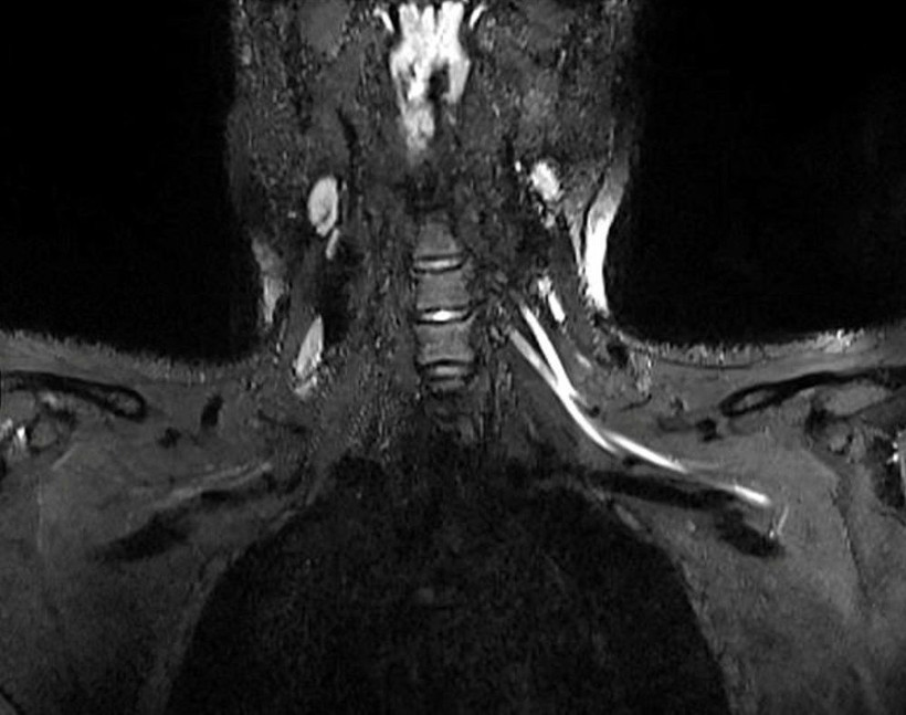 İlk kez görüntülendi! Koronavirüs sinir sisteminde bu hasarı yaratıyor - Resim: 3