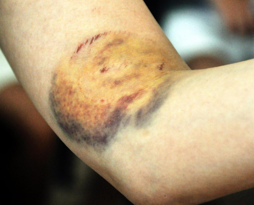 Caretta carettalar ısırdı onlar böyle poz verdi - Resim: 1