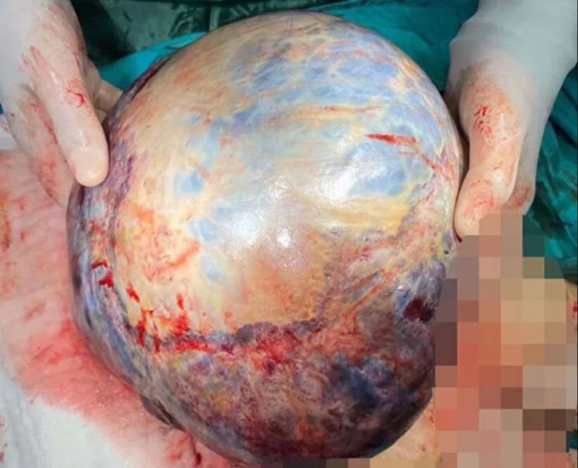 Nefes darlığı şikayetiyle hastaneye giden kadının karnından öyle bir şey çıktı ki! - Resim: 4