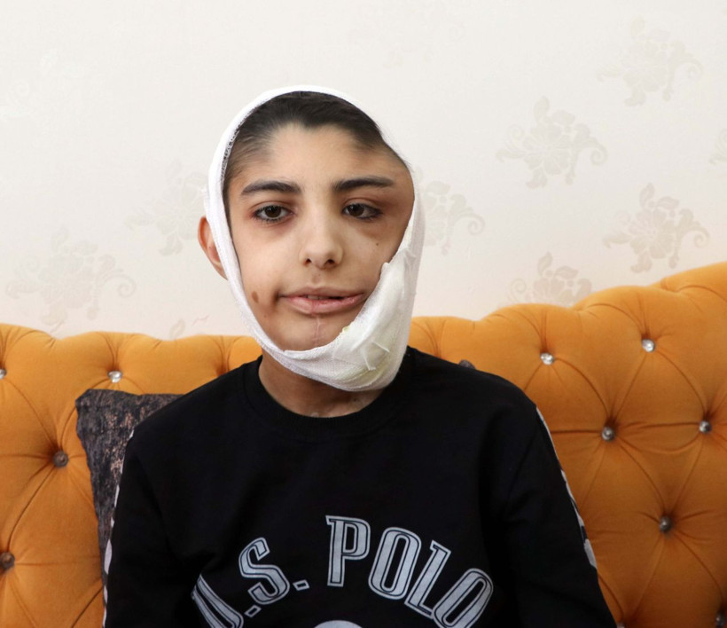 Gaziantep'te yüzünde çıktı bir daha kapanmadı! Berat'ın yarası her gün büyüyor - Resim: 1
