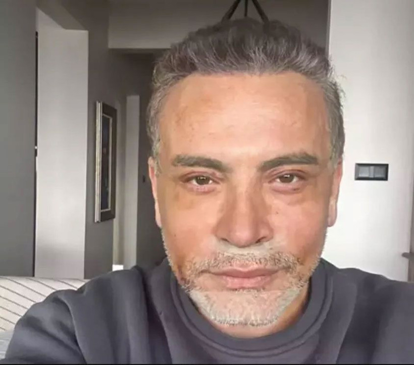 Ünlü şarkıcı tanınmaz hale geldi! Yüzünü gerdirdi - Resim: 2