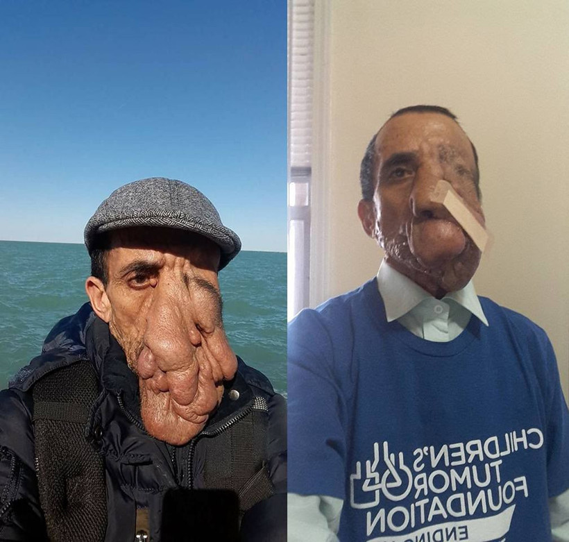 60 yıl yüzündeki 25 kilo tümör ile yaşadı 5 ameliyat geçirdi! Yıllar sonra huzura erdi - Resim: 4