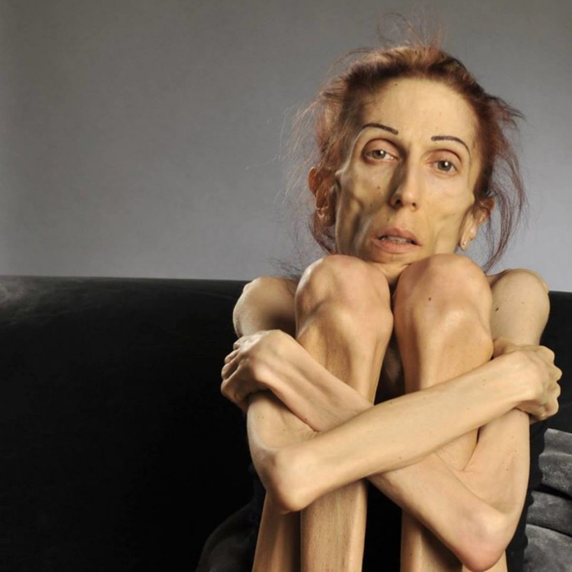 Diyet yapma uğruna... 18 kiloya kadar düştü! - Resim: 1