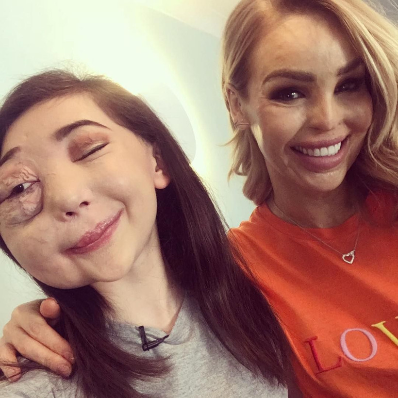 Facebook'tan tanıştığı adam tecavüz edip asitle yaktı ama o... - Resim: 1