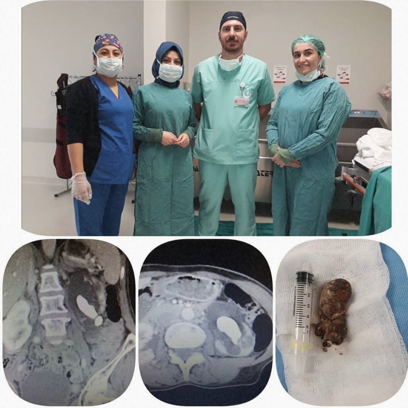 Aman dikkat her gün yiyoruz  Bu yiyecekler böbrek taşına neden oluyor - Resim: 2