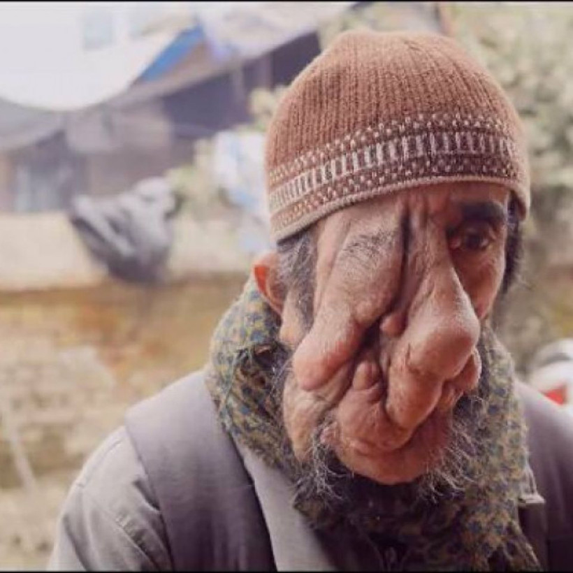 60 yıl yüzündeki 25 kilo tümör ile yaşadı 5 ameliyat geçirdi! Yıllar sonra huzura erdi - Resim: 3