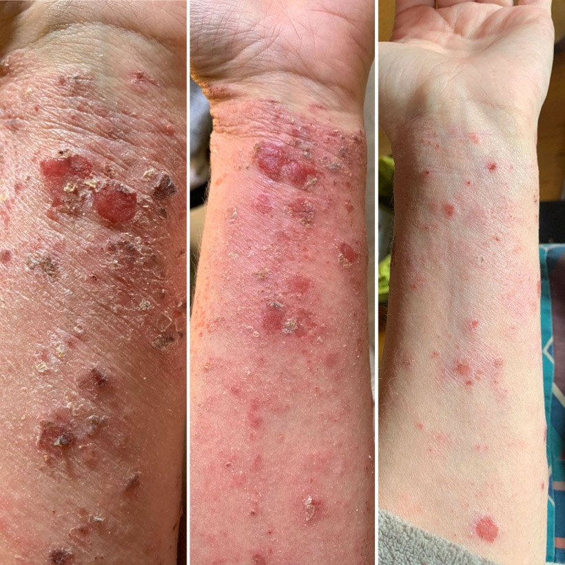 Egzama için kullandığı krem tanınmaz hale getirdi aylarca evden çıkmadı - Resim: 4