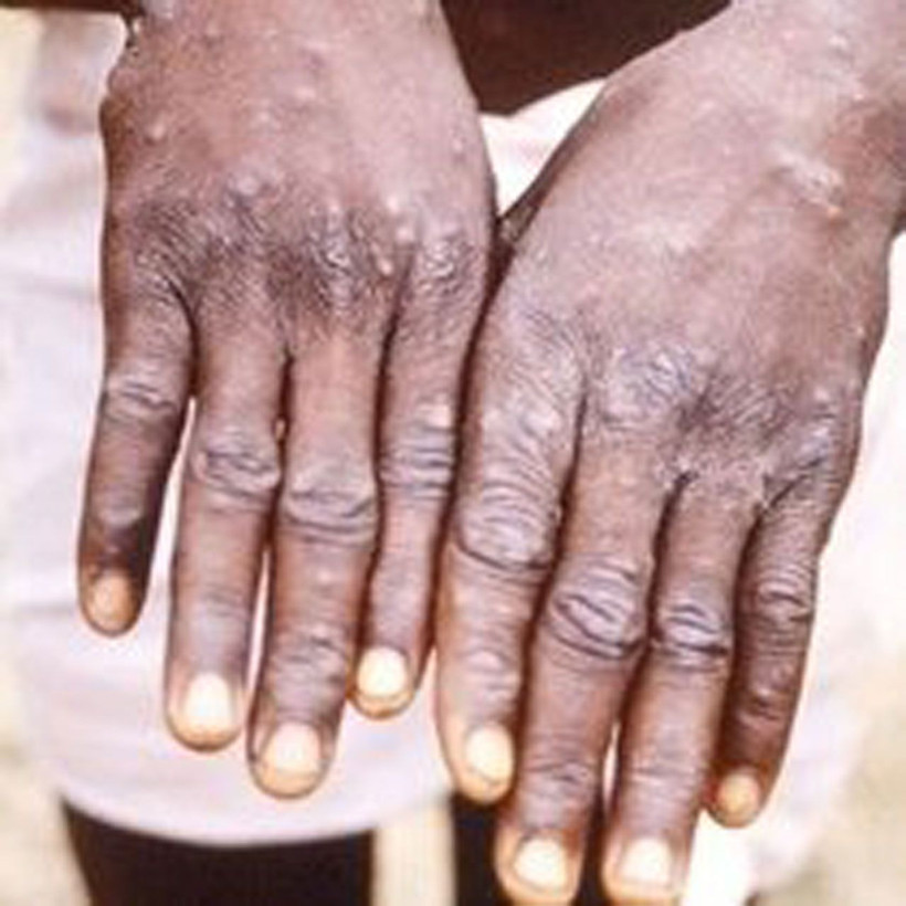 Kulaktan dolma bilgileri unutun! Maymun Çiçeği virüsü hakkında bilinmesi gerekenler - Resim: 3