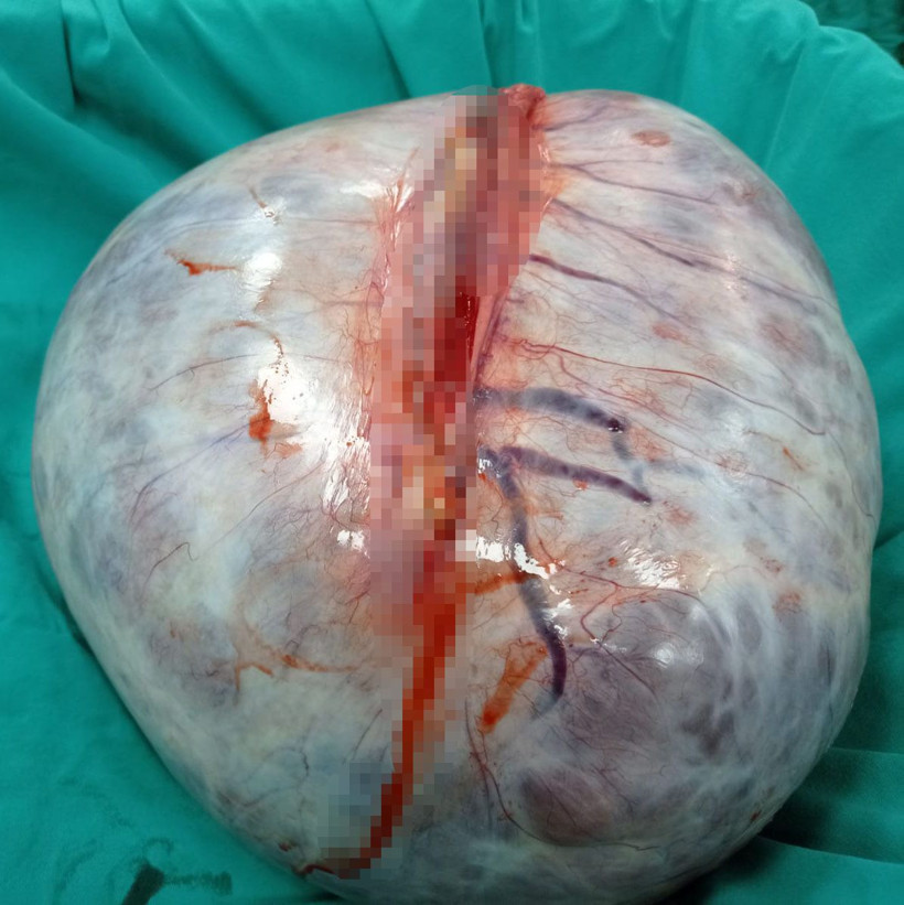 5 buçuk kilo ağırlığındaki tümör Niğde'de kadının karnından çıktı - Resim: 3