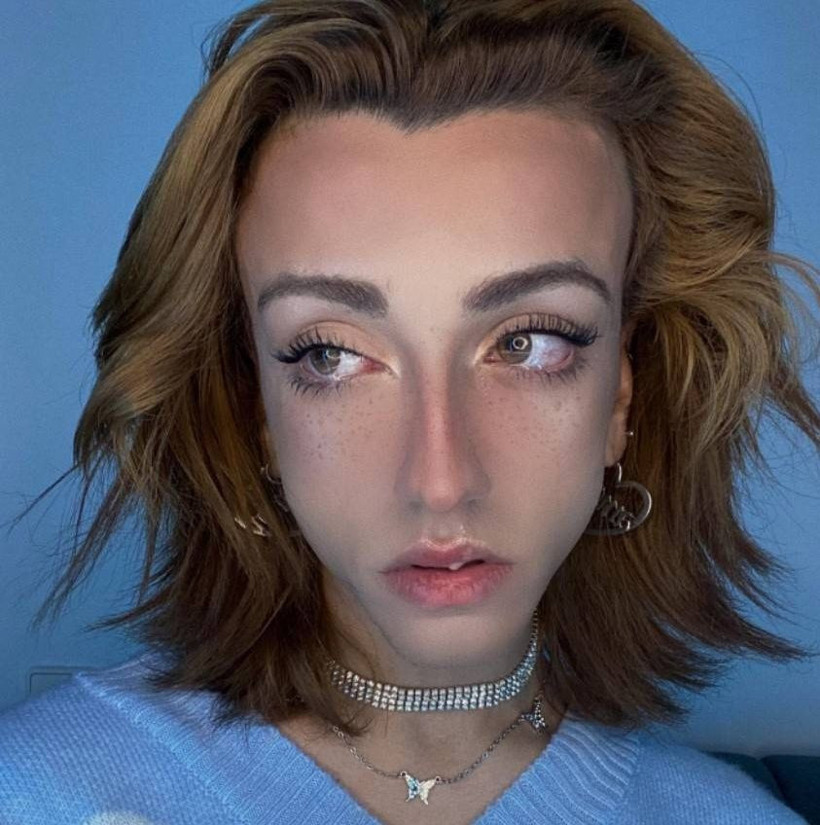 Mika Raun'un son hali görenleri şok etti! Estetik mağduru... - Resim: 2