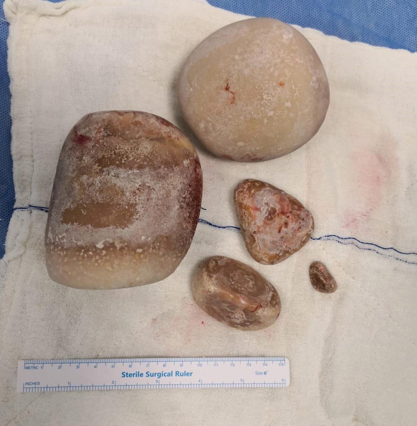 Denizli'de 18 yıllık doktor böylesini hiç görmedi! Mesanesinden çıktı hatıra olarak aldı - Resim: 2