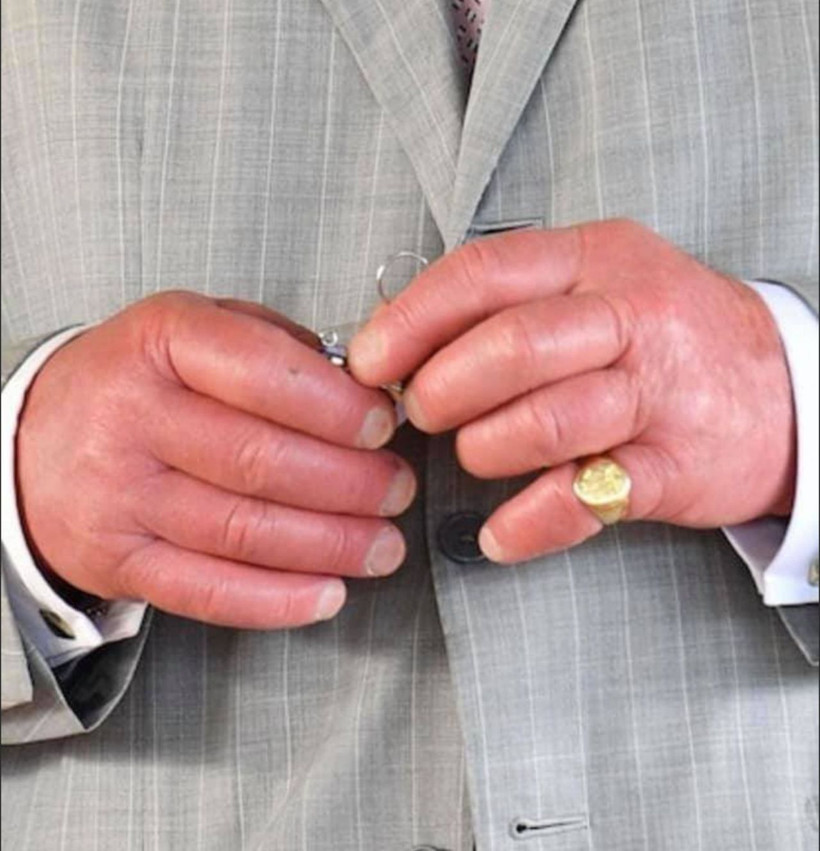 İngiltere Kralı Charles'in hastalığı ne? Sosis parmaklarından endişe yarattı - Resim: 4