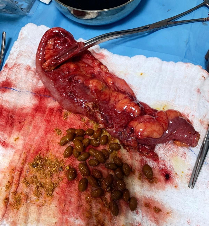 Aydın'da hastanın karnından çıkanlar şok etti! 50 adet zeytin çekirdeği ve incir... - Resim: 4