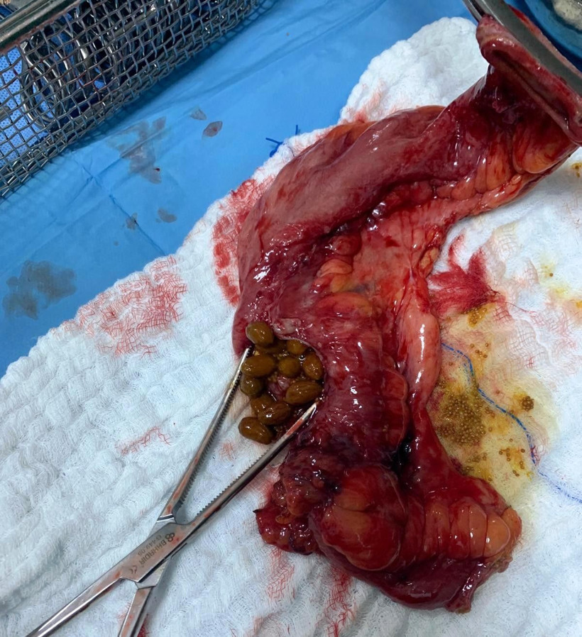 Aydın'da hastanın karnından çıkanlar şok etti! 50 adet zeytin çekirdeği ve incir... - Resim: 2