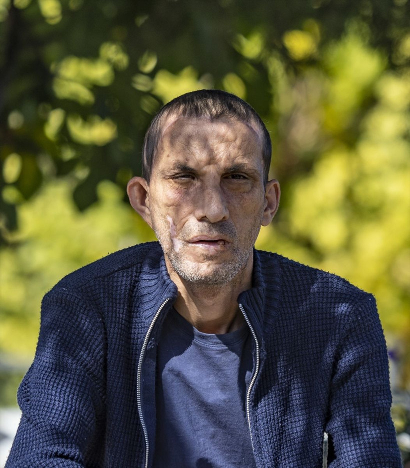 Türkiye'de ilk yüz nakli yapılan isimlerdi! Uğur Acar ve Turan Çolak'ın 10 yıl sonraki haline bakın - Resim: 3