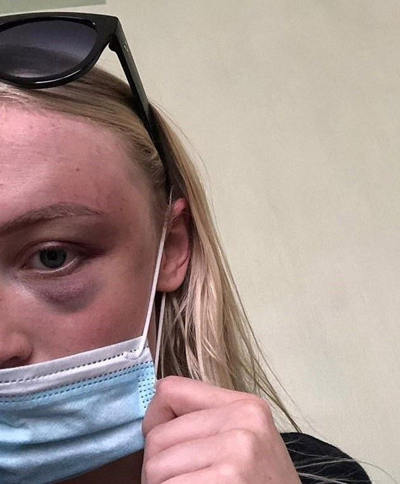 Kendi ifşa etti! Belçikalı manken Anthonia Rochus, sevgilisinden 20 kez şiddet görmüş - Resim: 4